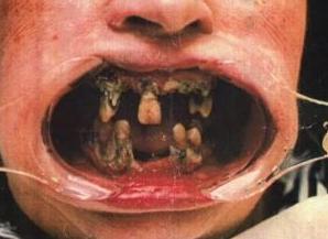 VOILA CE QUI SE PASSE SI ON NE PRENDS PAS SOIN DE SES DENTS ...